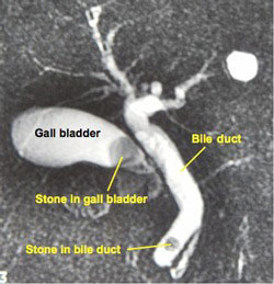 laparoscopic Cholecystectomy gurgaon