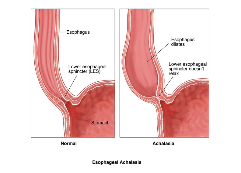 achalasia cardia surgery gurgaon