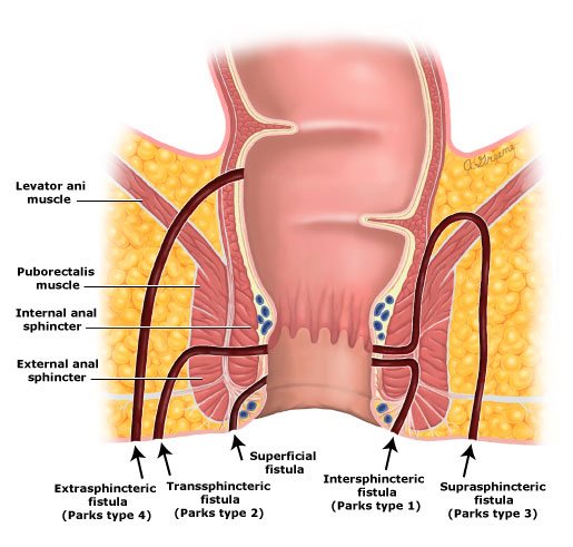 Anal Fistula Cure