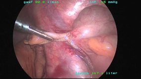 appendix removal gurgaon
