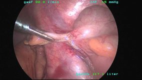appendicitis treatments gurgaon appendix removal gurgaon