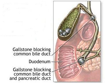 gall bladder stone surgery in gurgaon