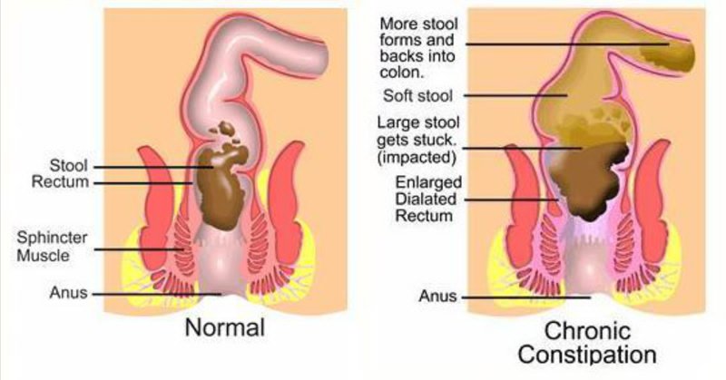 Surgery Treatment Of Chronic Constipation In Gurgaon Surgeon Doctor