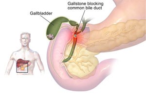 gall bladder stone surgery in gurgaon
