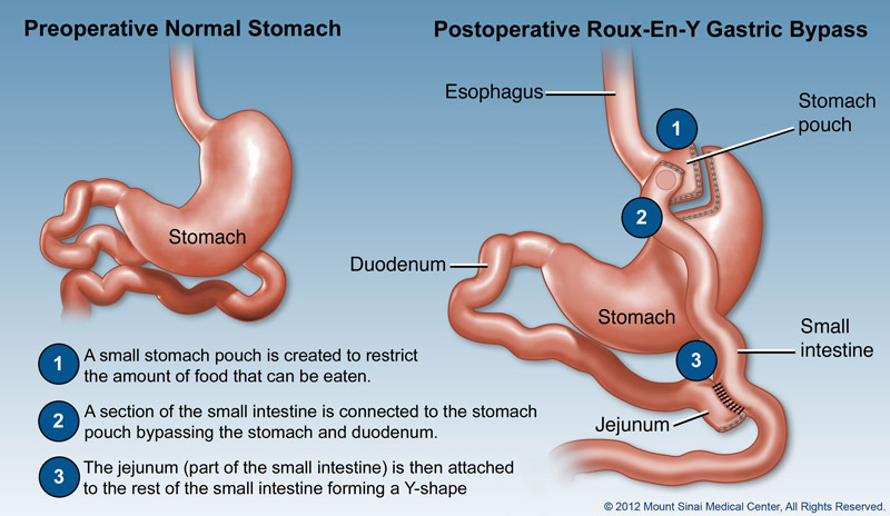 gastric bypass surgery in gurgaon