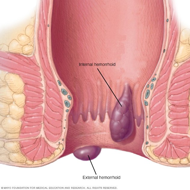 laser hemorrhoidoplasty in gurgaon