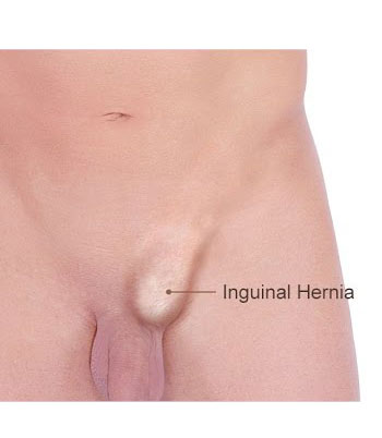 Best Incisional Hernia Doctor in Gurgaon
