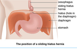 laparoscopic hernia surgery in gurgaon