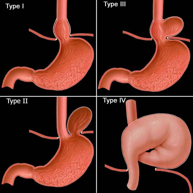 Laparoscopic Hiatus Hernia Repair in Gurgaon