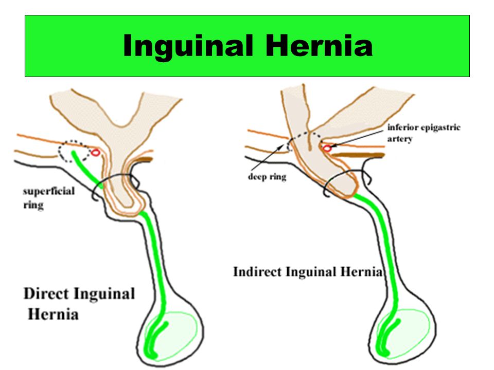 hernia treatment in gurgaon