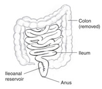 Intestinal Obstruction Treatment doctor In gurgaon ulcerative colitis Treatment Hospital In gurgaon