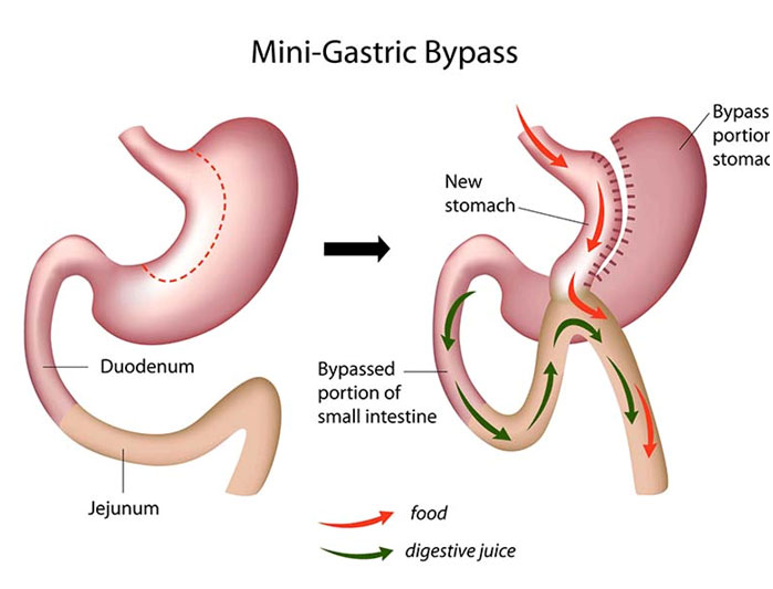 mini gastric surgery doctor gurgaon