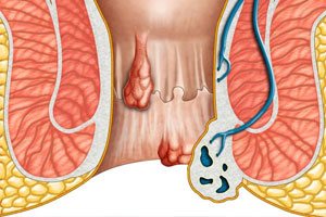 best doctor for piles in gurgaon laser treatments for piles in gurgaon