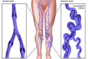 best laser varicose veins doctor gurgaon