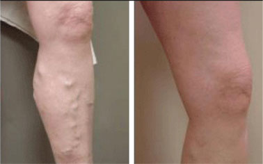 varicose veins treatment in gurgaon