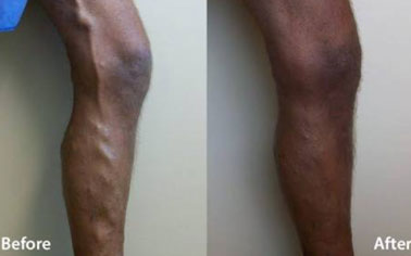 varicose veins surgeon in gurgaon