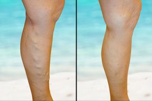 varicose veins treatment in gurgaon