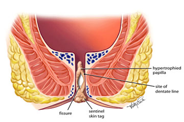 anal fissure treatment in gurgaon