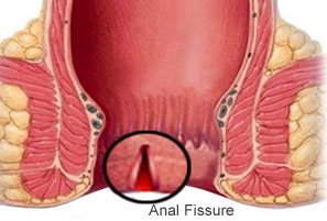 best doctor for fissure in gurgaon